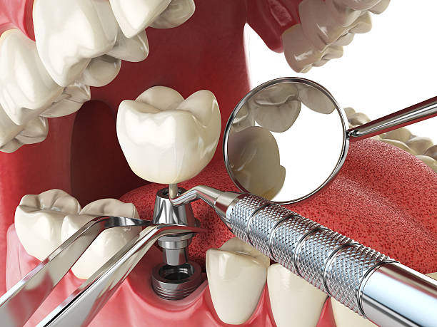 Best Emergency Dental Extractions in Splendora, TX